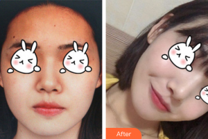 廣州從化現(xiàn)代醫(yī)院劉攸香整形價(jià)格表附無針?biāo)獍咐故?>
</a>
<h3 class=