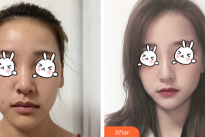 廣州尚美善造美容醫(yī)院李青姍整形價(jià)格表附無針?biāo)獍咐故?>
</a>
<h3 class=