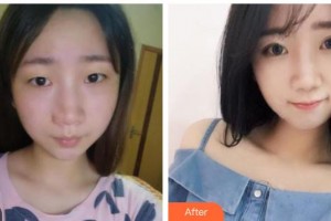 福建醫(yī)科大學(xué)附屬第一醫(yī)院整形美容外科王美水整形價(jià)格表附眼部整形案例展示