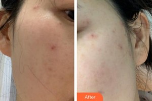 福建武警總隊(duì)醫(yī)院激光美容中心文維整形價(jià)格表附雙激光美膚案例展示