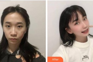 福建醫(yī)科大學附屬第二醫(yī)院眼科中心王鳳整形價格表附眼部整形案例展示