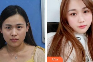 福建醫(yī)科大學(xué)附屬第二醫(yī)院眼科中心胡建民整形價(jià)格表附眼部整形案例展示