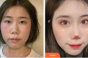 福建醫(yī)科大學附屬協(xié)和醫(yī)院整形激光美容中心陳小松整形價格表附阿爾法雙眼皮案例展示