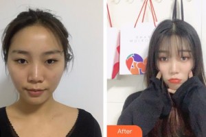 福建醫(yī)科大學附屬第二醫(yī)院眼科中心高瑩瑩整形價格表附眼部整形案例展示