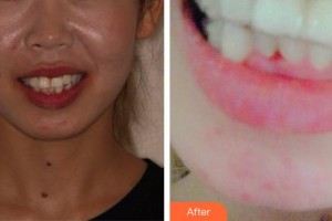 福建醫(yī)科大學附屬口腔醫(yī)院陳江整形價格表附隱形矯正案例展示