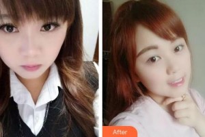 福建醫(yī)科大學附屬口腔醫(yī)院張端強整形價格表附牙齒隱形矯正案例展示