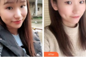 福建醫(yī)科大學附屬口腔醫(yī)院盧友光整形價格表附牙齒瓷貼面案例展示