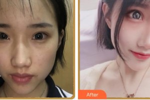 福建醫(yī)科大學附屬第一醫(yī)院整形美容外科王彪整形價格表附自體脂肪填充案例展示