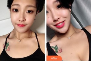 福建醫(yī)科大學附屬第一醫(yī)院整形美容外科黃循鐳整形價格表附濃縮豐胸真實案例展示