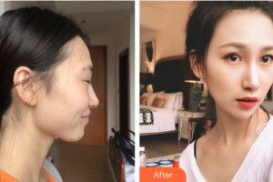 福州臺江醫(yī)院整形美容中心鐘波整形價格表附DA·頜面整形案例展示