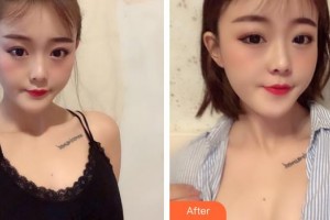 福州臺江醫(yī)院整形美容中心包德瑞整形價格表附濃縮豐胸真實案例展示