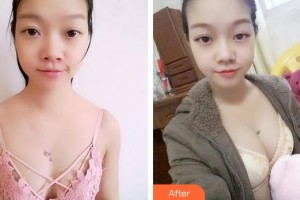 福州臺江醫(yī)院整形美容中心王炳整形價格表附豐胸案例展示