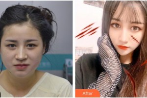 福州愛思特比華利整形美容醫(yī)院張敏整形價格表附面部輪廓案例展示