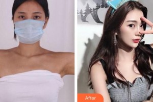 福州臺江醫(yī)院整形美容中心孫森整形價格表附假體隆胸案例展示