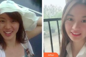 福州莎菲琳(弘宇)整形美容醫(yī)院林婷整形價格表附牙綜合案例展示