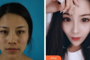 福州海峽美容醫(yī)院王英勇整形價格表附鼻部手術案例展示