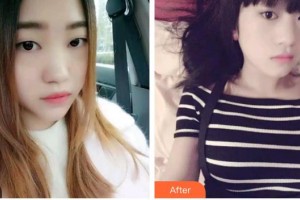 福州海峽美容醫(yī)院賀寶陣整形價格表附牙齒金屬矯正案例展示