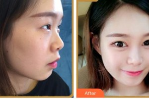 福州美萊華美美容醫(yī)院何宜新整形價格表附下頜角整形案例展示