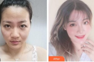 福州市第八人民醫(yī)院整形美容科許金玲整形價格表附發(fā)際線種植案例展示