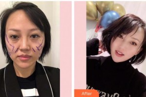 福州愛美爾整形美容醫(yī)院邱富美整形價格表附抗初老熱瑪吉案例展示