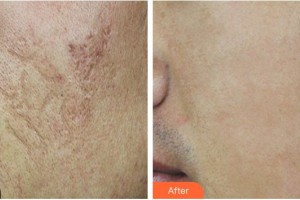 福州愛(ài)思特比華利整形美容醫(yī)院林秋蓉整形價(jià)格表附凹陷疤痕案例展示