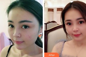 福州美萊華美美容醫(yī)院徐爽整形價(jià)格表附疤痕案例展示