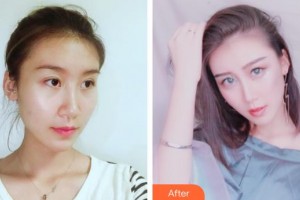 福州隆美爾整形美容醫(yī)院謝義德整形價(jià)格表附隆鼻案例展示