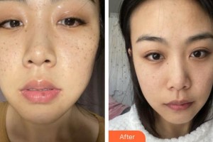 福州美貝爾醫(yī)療美容門(mén)診部姚文華整形價(jià)格表附超激光美膚祛斑案例展示