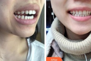 福州愛(ài)思特比華利整形美容醫(yī)院強(qiáng)副主任 主診醫(yī)師整形價(jià)格表附牙齒矯正案例展示