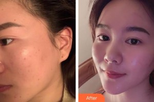 福州美萊華美美容醫(yī)院池卿整形價(jià)格表附激光美膚激光案例展示