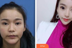 福州臺(tái)江醫(yī)院整形美容中心林麗德整形價(jià)格表附鼻部整形案例展示