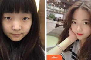 福州美萊華美美容醫(yī)院王燦整形價(jià)格表附切開(kāi)雙眼皮案例展示