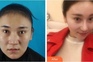 福州名韓整形美容醫(yī)院溫名赟整形價(jià)格表附鼻部整形案例展示