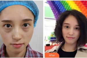 福州市第八人民醫(yī)院整形美容科高征天整形價(jià)格表附祛眼袋案例展示