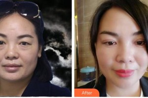 福州海峽美容醫(yī)院陳藝清整形價(jià)格表附不開(kāi)刀雙眼皮案例展示