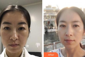 福州海峽美容醫(yī)院池美秀整形價(jià)格表附熱瑪吉案例展示