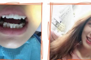 福州海峽美容醫(yī)院柳書(shū)喻整形價(jià)格表附隱形托槽矯正案例展示