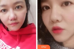 福州臺(tái)江醫(yī)院整形美容中心虞守輝整形價(jià)格表附埋線提升案例展示