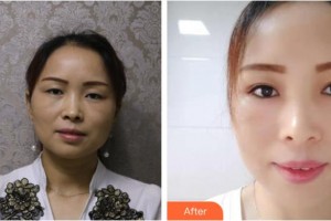 福州中聯(lián)美康整形美容醫(yī)院蔡群整形價(jià)格表附切開(kāi)雙眼皮案例展示