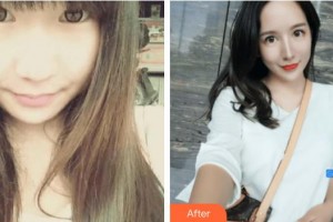 福州臺(tái)江醫(yī)院整形美容中心李海英整形價(jià)格表附鼻部整形案例展示