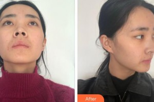 福州名韓整形美容醫(yī)院光整形價(jià)格表附鼻部手術(shù)案例展示