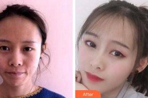 福州海峽美容醫(yī)院劉大慶整形價(jià)格表附埋線提升案例展示