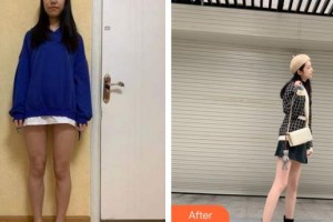 福州臺(tái)江醫(yī)院整形美容中心金永圭整形價(jià)格表附大腿吸脂案例展示