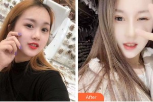 福州愛(ài)思特比華利整形美容醫(yī)院劉耀美整形價(jià)格表附眼部手術(shù)案例展示