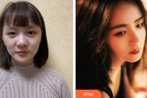 福州中意醫(yī)療美容門(mén)診部金成基整形價(jià)格表附肋軟骨隆鼻案例展示