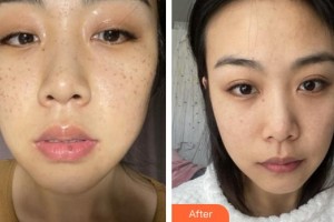 福州秀清醫(yī)療美容診所鐘玉鳳整形價格表附祛斑案例展示