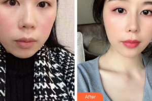 廣州華醫(yī)醫(yī)療美容門診部鐘學(xué)成整形價(jià)格表附耳軟骨復(fù)合隆鼻案例展示