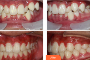 廣州華醫(yī)醫(yī)療美容門診部陳宏錦整形價(jià)格表附隱適美牙齒矯正案例展示