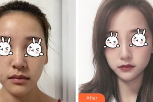 福州美萊華美美容醫(yī)院陳力楊整形價格表附下巴注射結(jié)合嗨體、線材改良嘟案例展示