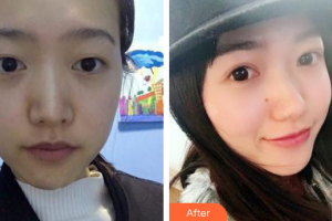 廣州基立嘉韓醫(yī)學(xué)整形美容醫(yī)院黃軍彬整形價(jià)格表附眼部整形案例展示